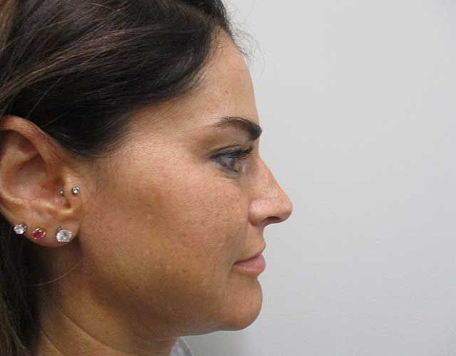 Cheeks Before & After