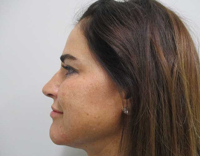 Cheeks Before & After