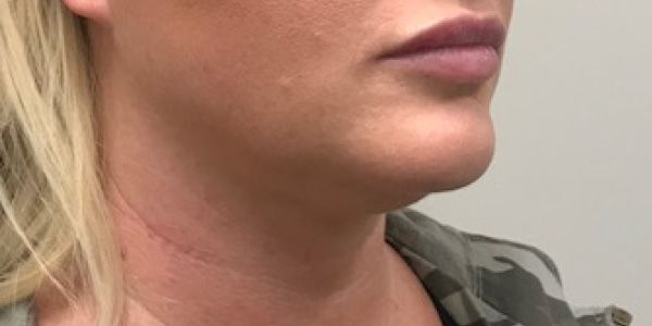 Kybella Before & After