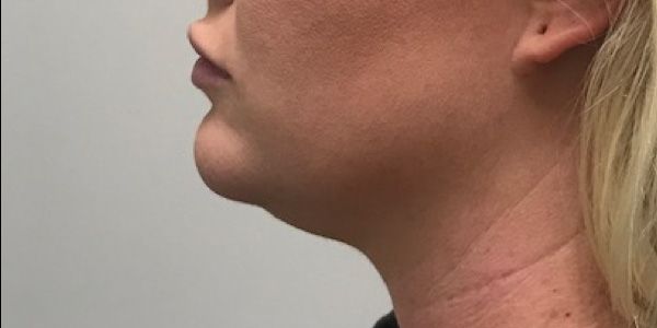 Kybella Before & After