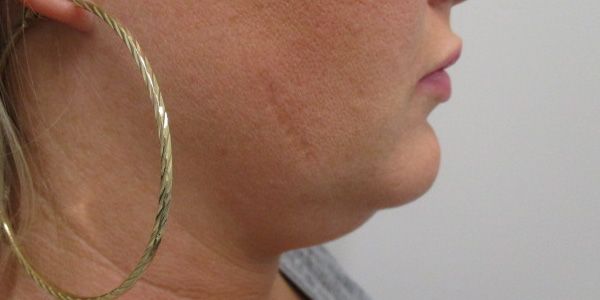 Kybella Before & After