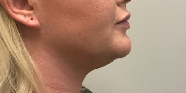 Kybella Before & After