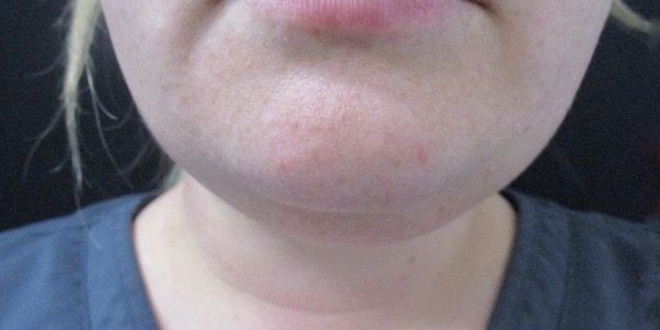 Kybella Before & After