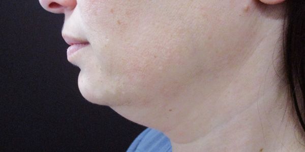 Kybella Before & After