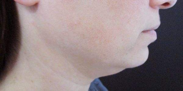 Kybella Before & After