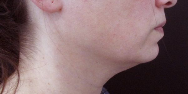 Kybella Before & After