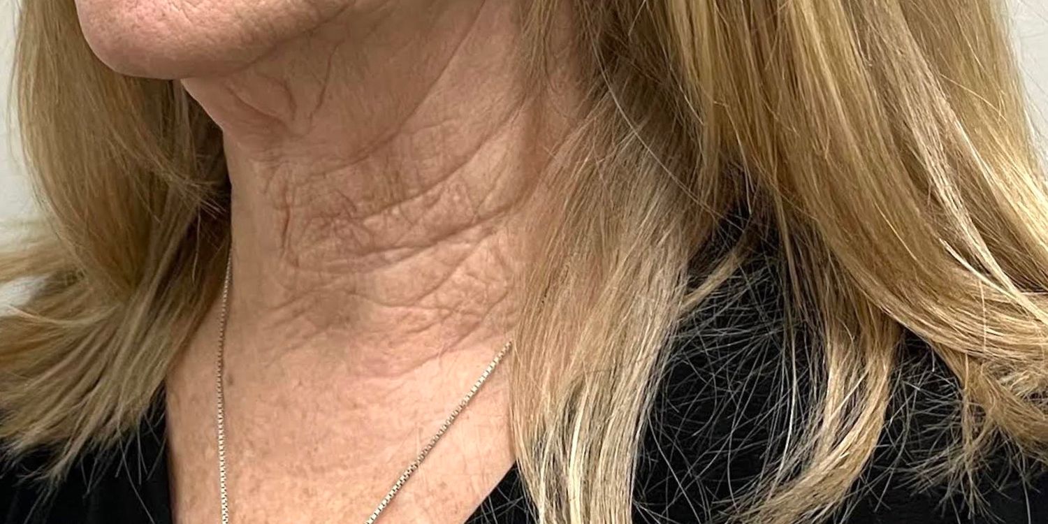 Kybella | Liquid Lipo Before & After