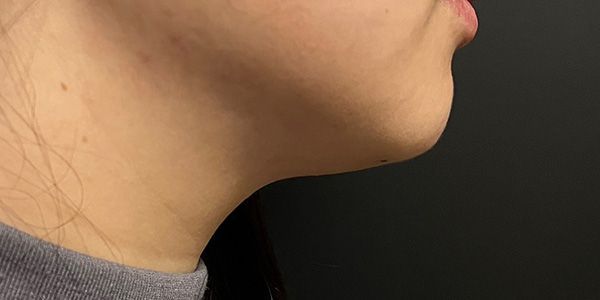 Kybella Before & After