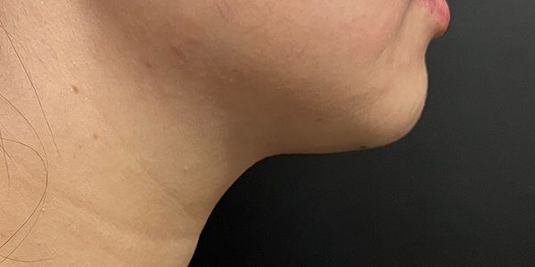 Kybella Before & After