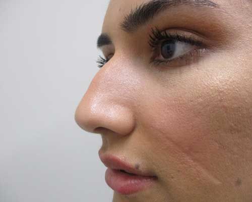 Liquid Rhinoplasty Before & After