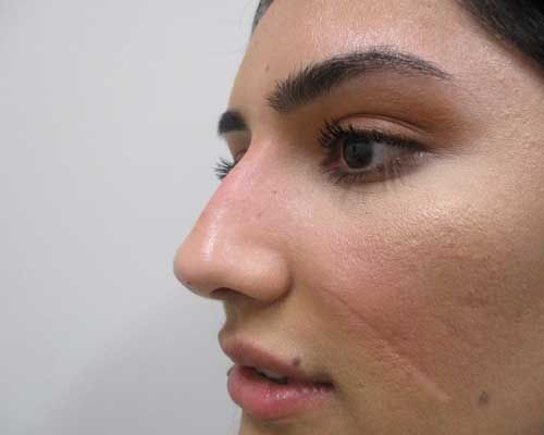 Liquid Rhinoplasty Before & After