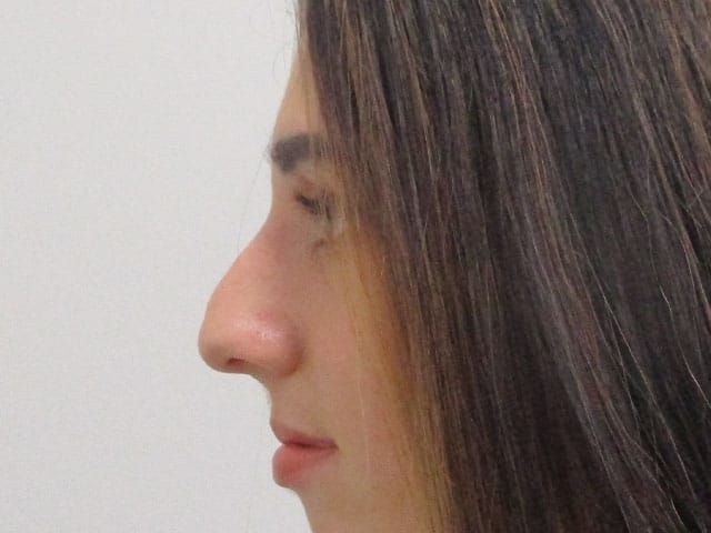 Liquid Rhinoplasty Before & After