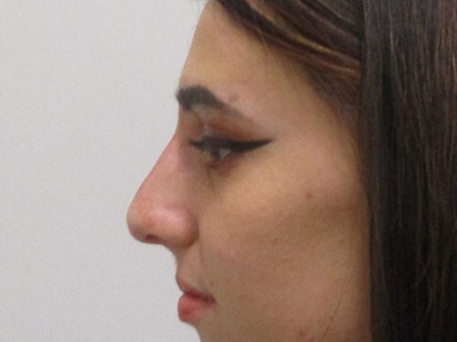 Liquid Rhinoplasty Before & After