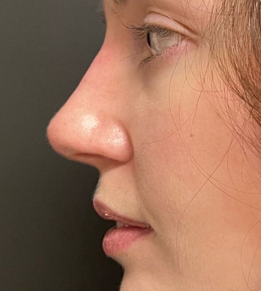 Liquid Rhinoplasty Before & After