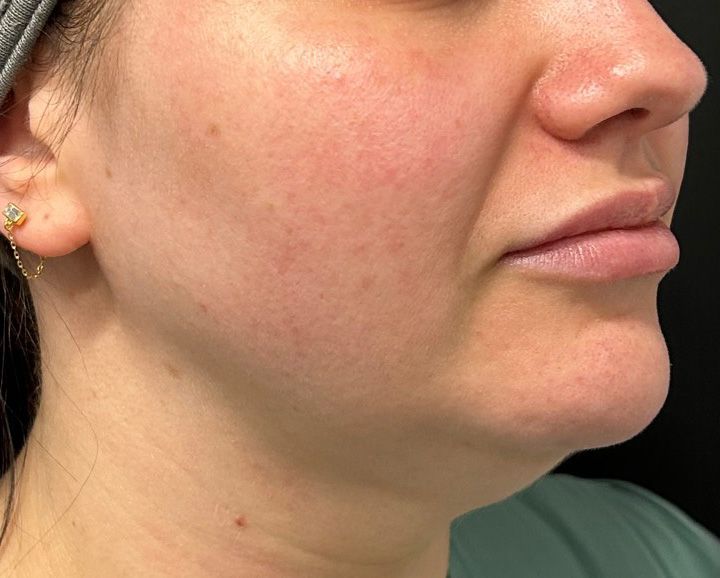 GloTox Infusion Before & After