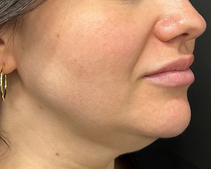 GloTox Infusion Before & After