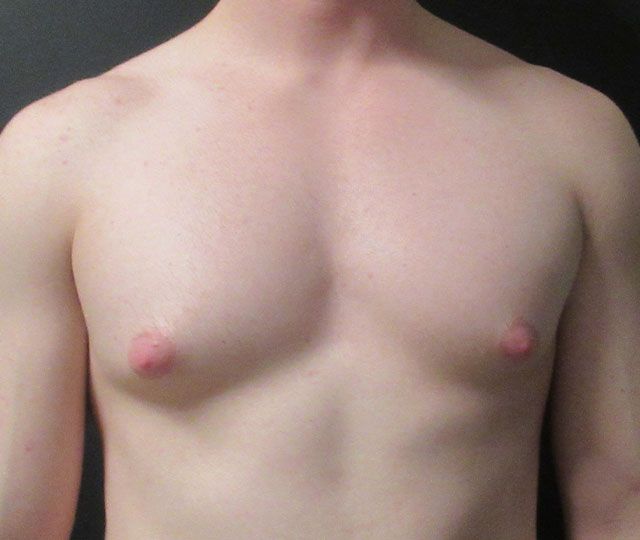 Male Breast Reduction Before & After