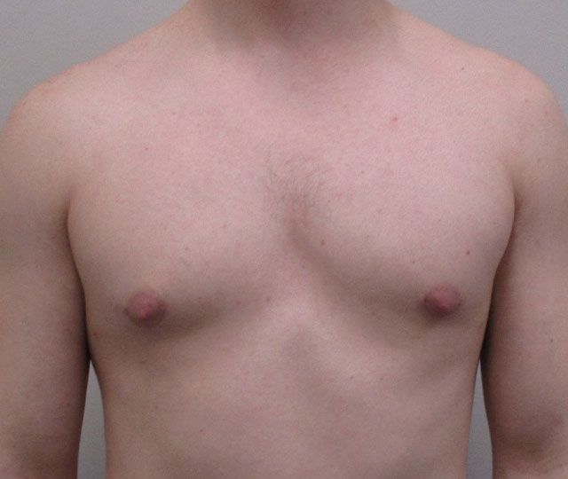 Male Breast Reduction Before & After