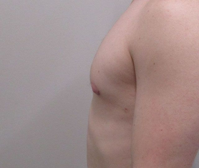 Male Breast Reduction Before & After