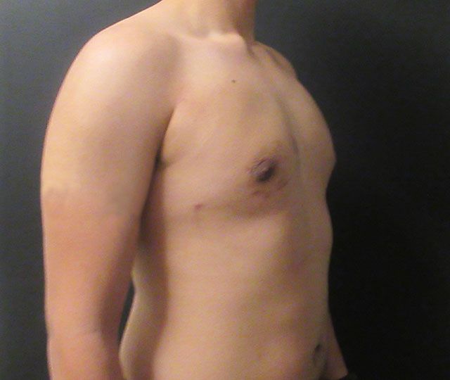 Male Breast Reduction Before & After