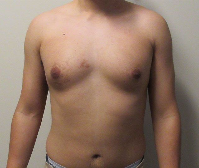 Male Breast Reduction Before & After