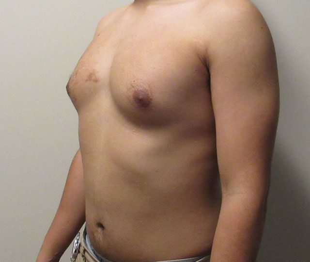 Male Breast Reduction Before & After