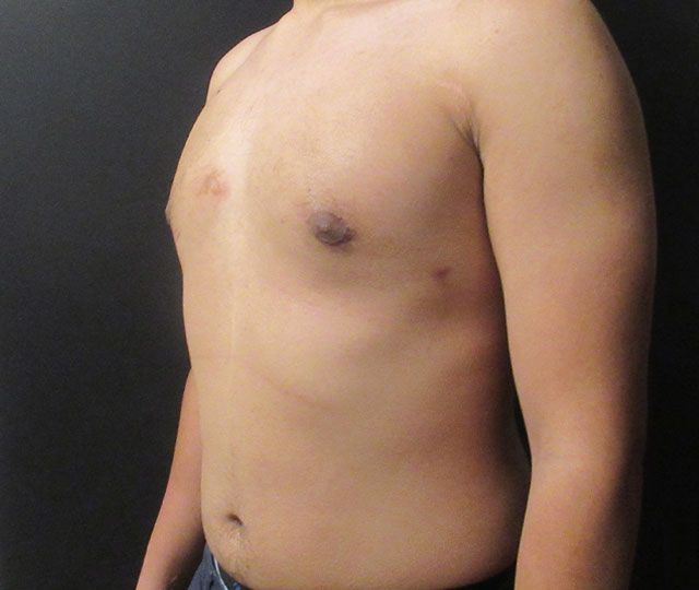 Male Breast Reduction Before & After