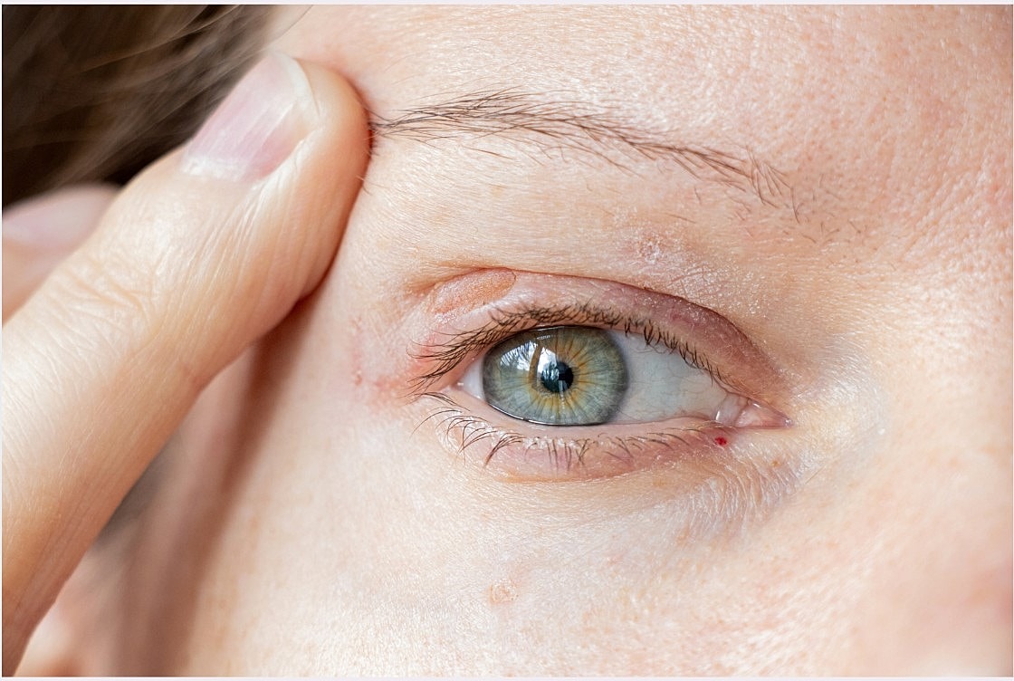 Blepharoplasty: The Eyelid Surgery Guide That Answers Your Biggest Questions