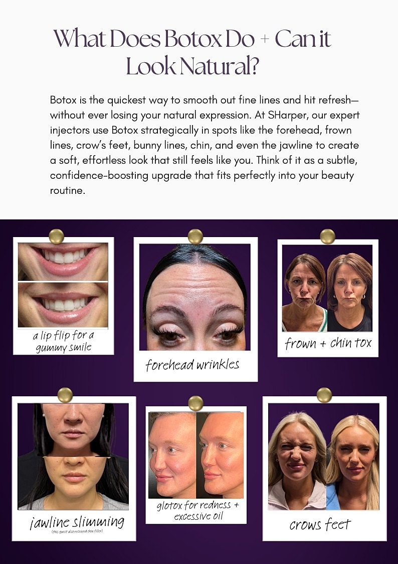 Botox benefits for a natural appearance explained.